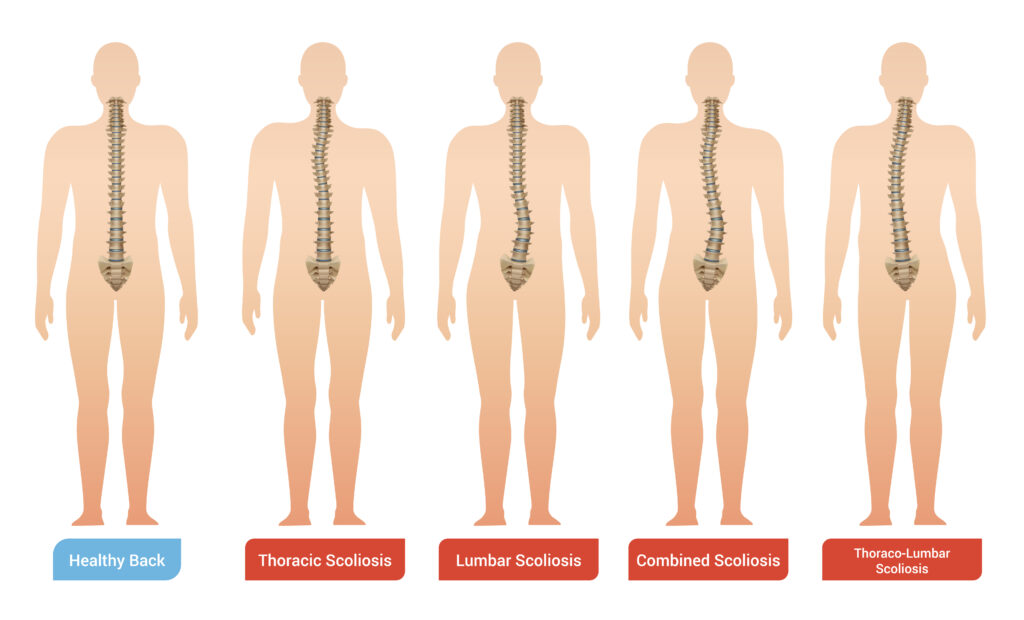 Type of Scoliosis