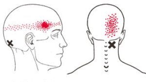 Sakit Kepala Tegang (Tension Headache)