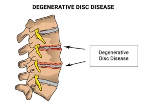 Cervical Osteoarthritis