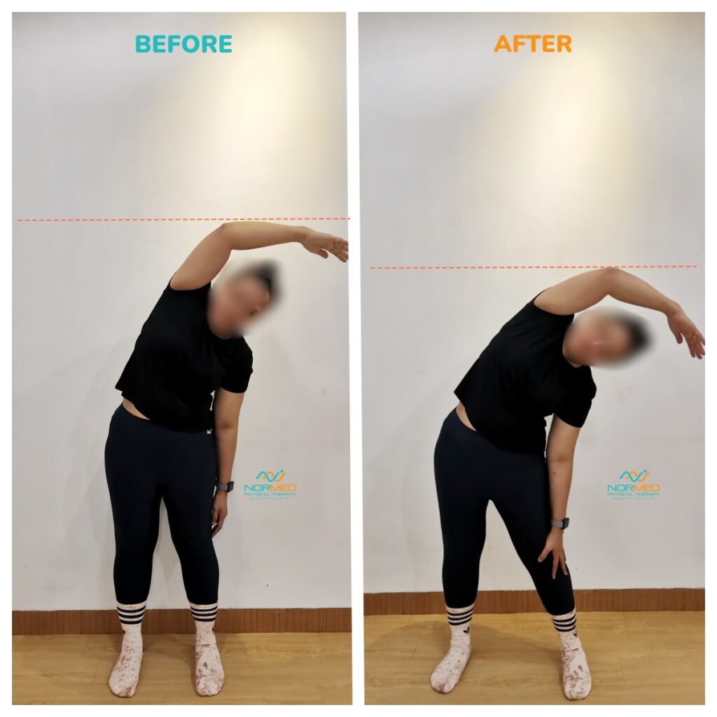 Improvement of client in bending to the left after posture fit group class.